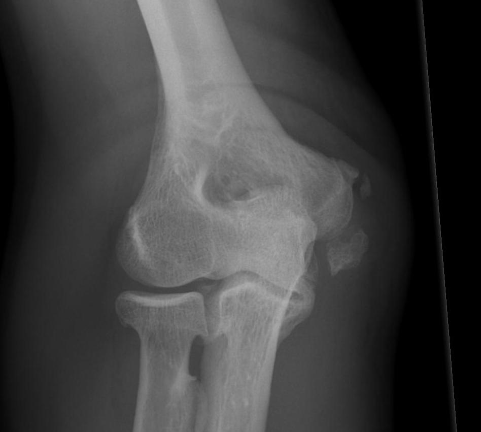 Elbow Medial Condyle Fracture